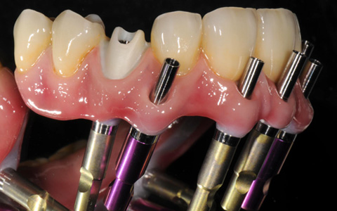 Aditamentos Implantológicos